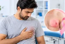 male breast cancer awareness who